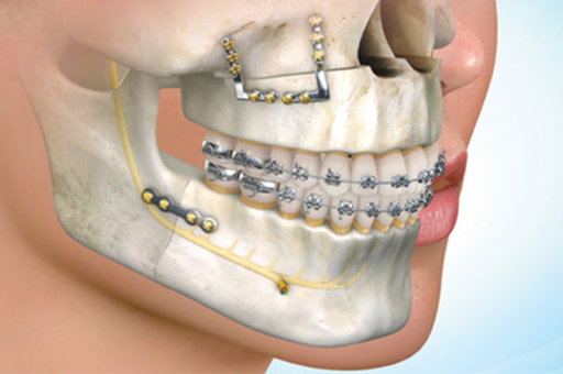Jaw with Braces showing Oral and Maxillofacial Surgery
